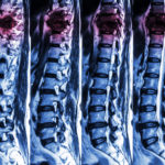 spinal injuries attorney in el cajon spinal injuries attorney in el cajon